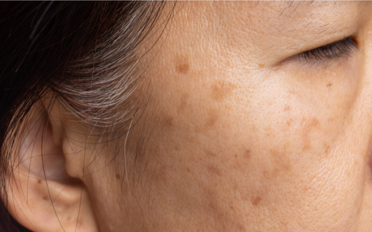 “Close-up image of mature skin with age spots and sun damage on the cheek.”